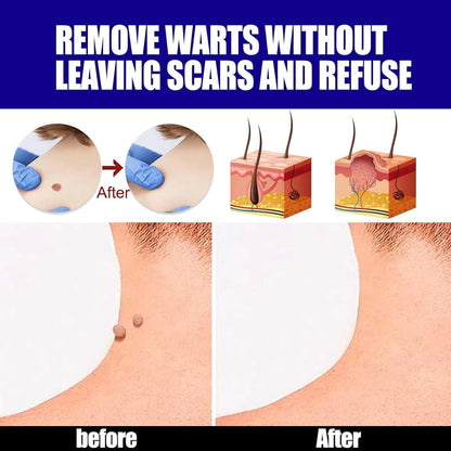Wart Remover Ointment